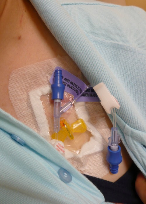 Accessed Power Port for chemo Accessed Power Port for chemo